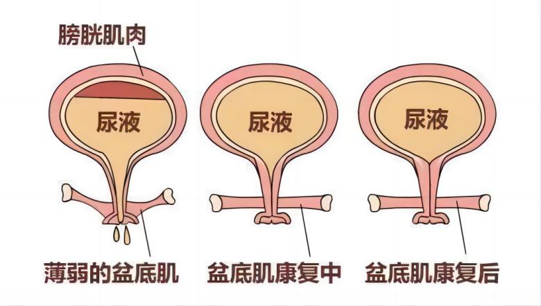 羽豐醫(yī)療丨如何有效運(yùn)用振動(dòng)提高盆底肌肉激活水平？